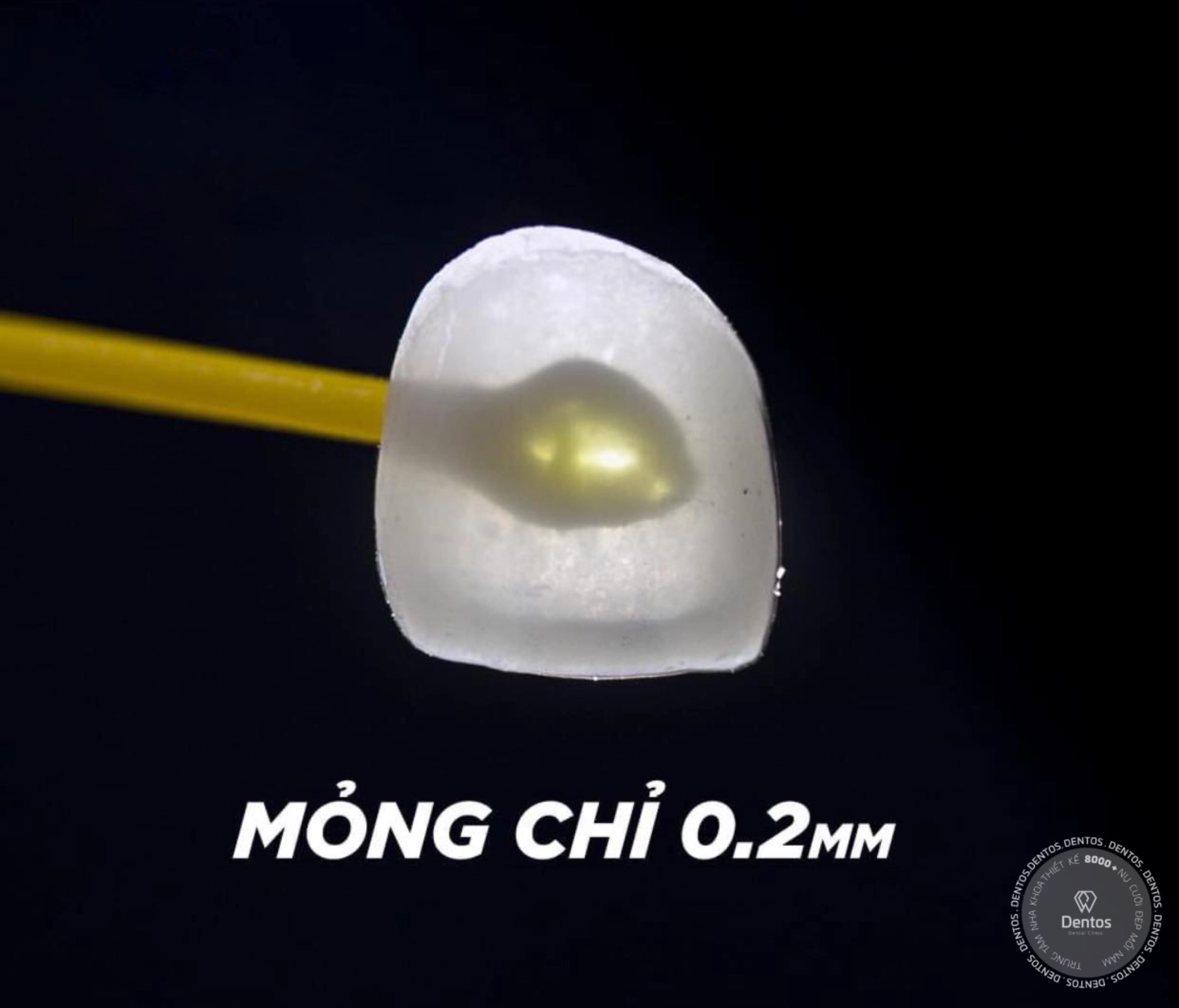 Dán sứ veneer có kích thước siêu mỏng nhẹ (chỉ từ 0.3 - 0.5mm)